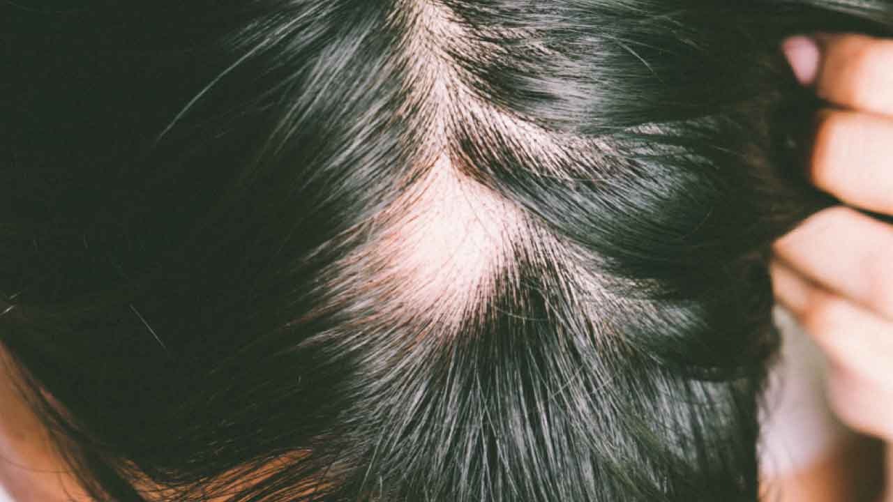Scarring Alopecia Scarring Alopecia