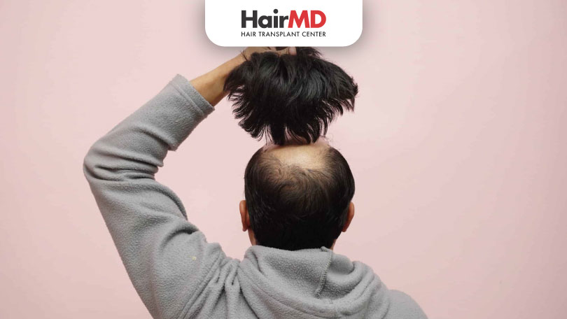 What-are-the-Side-Effects-of-Wearing-Wigs-HairMD-Pune Side effects of wearing wigs