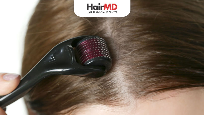 Right Way to Use Dermaroller for Hair Loss
