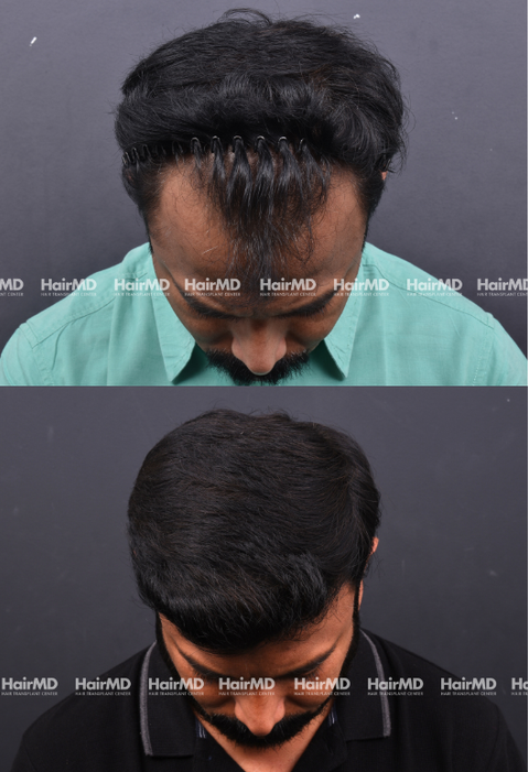 35-year old male Hair Transplant Results 2-Years 4000-5000 Grafts HairMD Pune