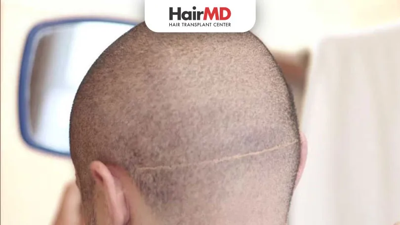 Are-Hair-Transplant-Scar-Visible-HairMD-Pune Are Hair Transplant Scar Visible HairMD Pune