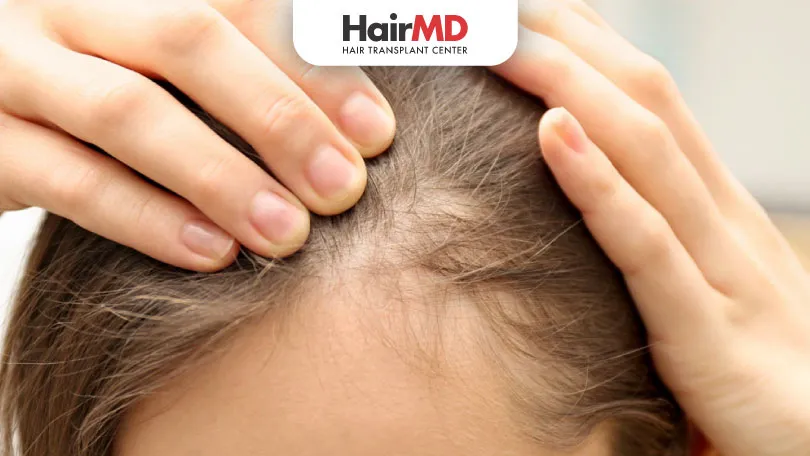 Does-Minoxidil-Work-for-Women’s-Hair-Loss-HairMD-Pune Does Minoxidil Work for Women’s Hair Loss HairMD Pune