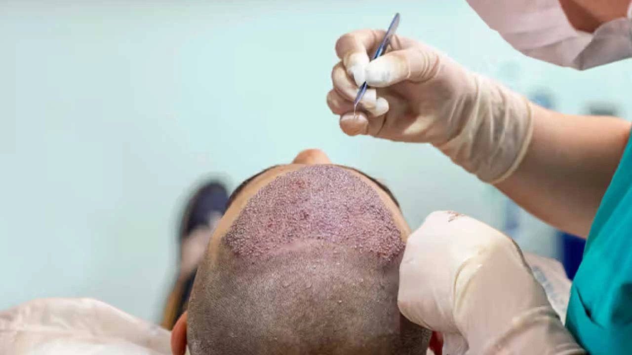 Fue-Hair-Transplant Fue Hair Transplant