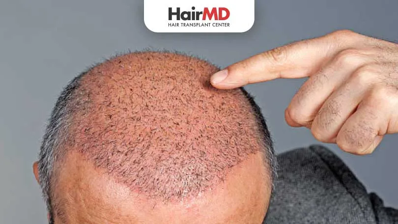 How Long Does it Take to Grow Hair After Hair Transplant HairMD Pune