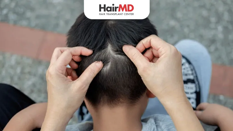 How-Much-Hair-Loss-is-Normal-for-Teenage-Male Hair Loss in teenage male