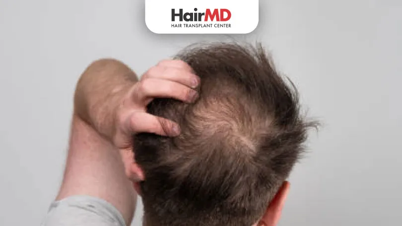 How-to-Stop-Hair-Shedding-After-an-Accident how to stop hair shedding after accident