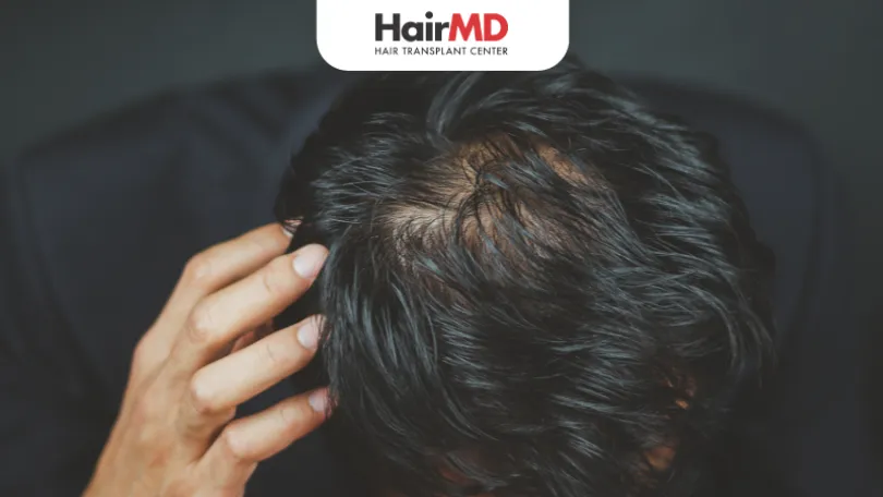 oily sclap after hair transfer oily scalp after hair transfer