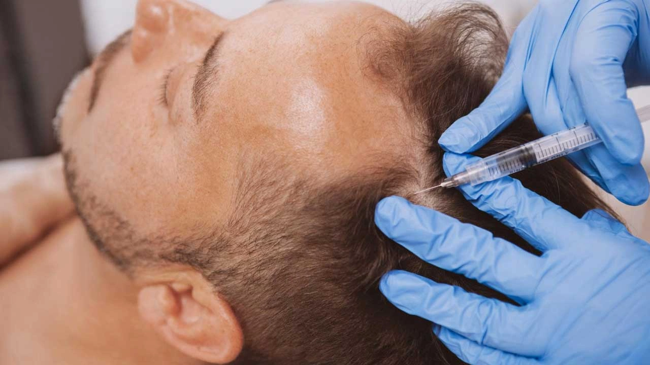 Platelet-Rich-Plasma-Therapy Platelet Rich Plasma Therapy
