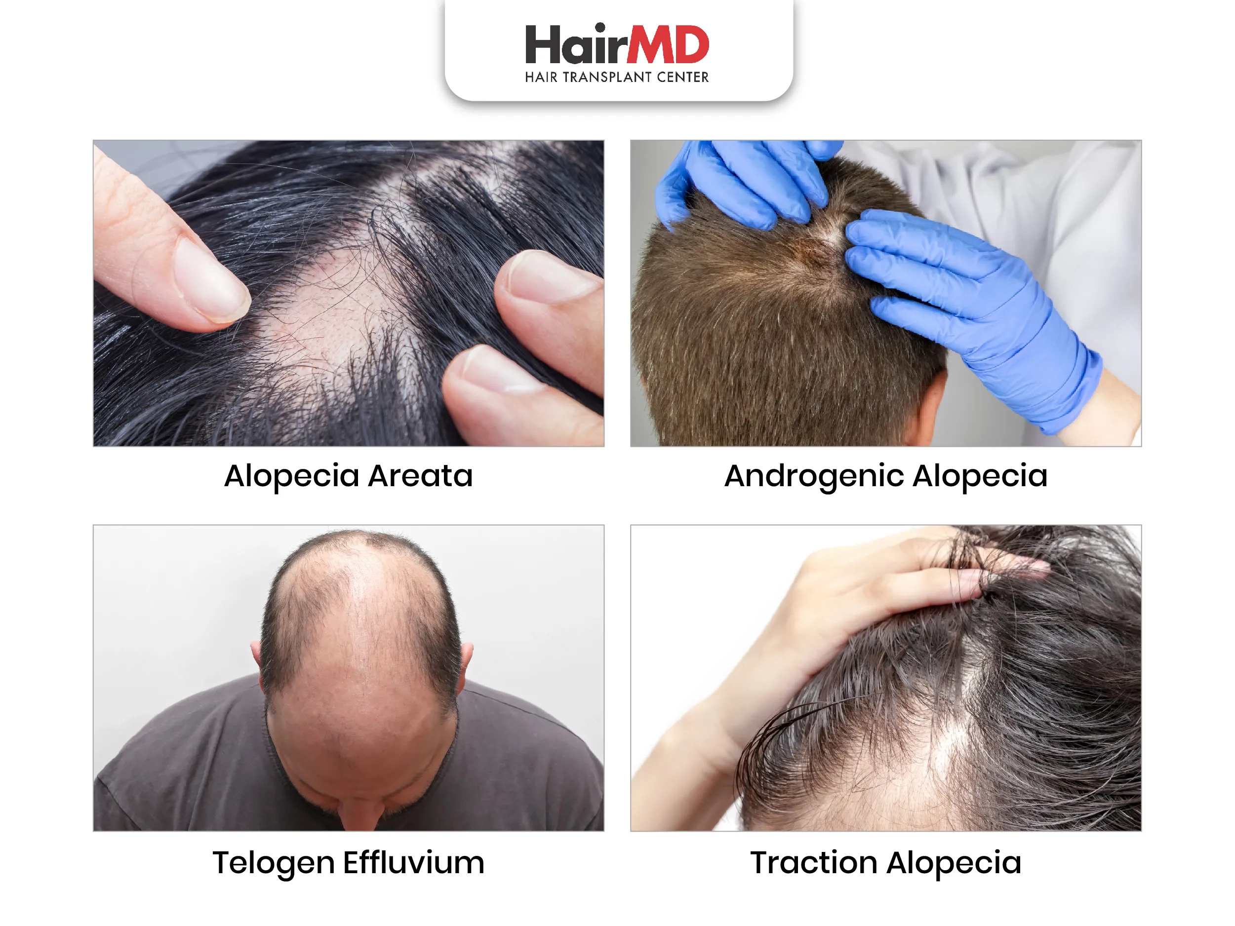 Types of alopecia Types of alopecia