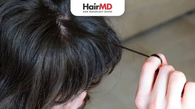 What-are-the-Permanent-Solutions-for-Hair-Pulling-Disorder-HairMD-Pune What are the Permanent Solutions for Hair Pulling Disorder HairMD Pune