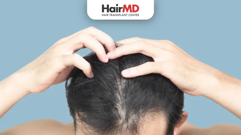 What-Is-Minoxidil-Shedding-HairMD-Pune What Is Minoxidil Shedding HairMD Pune