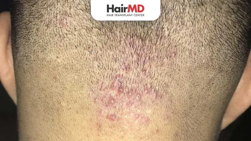 What-is-the-Fastest-Way-to-Heal-Folliculitis-HairMD-Pune What is the Fastest Way to Heal Folliculitis HairMD Pune