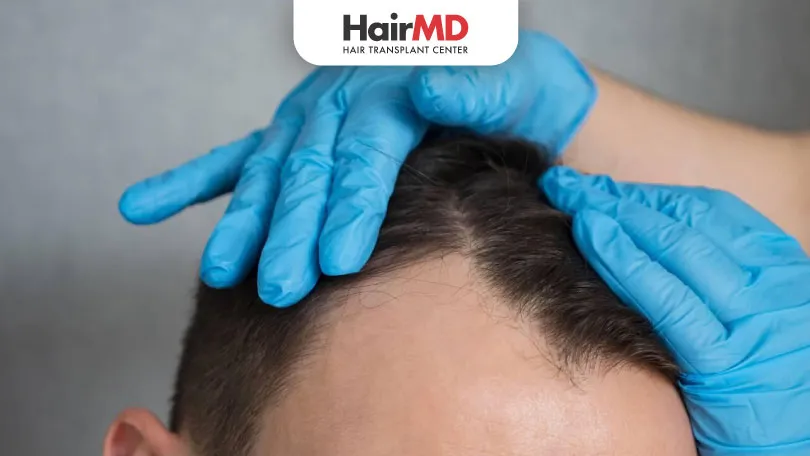 What-is-the-Minimum-Age-for-Hair-Transplant-HairMD-Pune What is the Minimum Age for Hair Transplant HairMD Pune