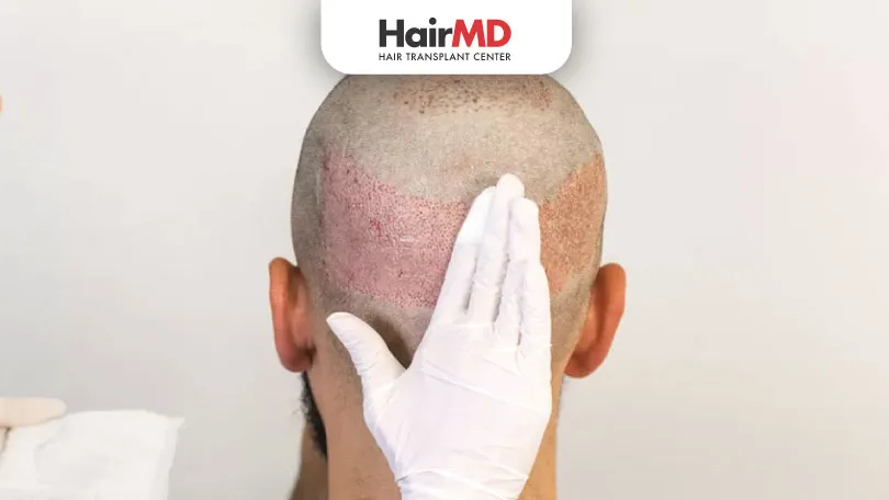 What-medications-should-be-taken-after-a-hair-transplant medication after hair transplant