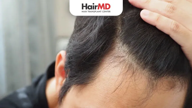 What-Works-Best-for-Baldness-–-Home-Remedies-Vs-Treatment-by-Specialist-HairMD-Pune What Works Best for Baldness Home Remedies Vs Treatment by Specialist HairMD Pune