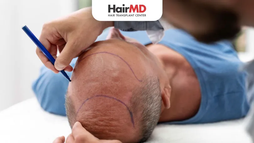 When-is-the-Best-Time-for-Hair-Transplant-HairMD-Pune When is the Best Time for Hair Transplant HairMD Pune